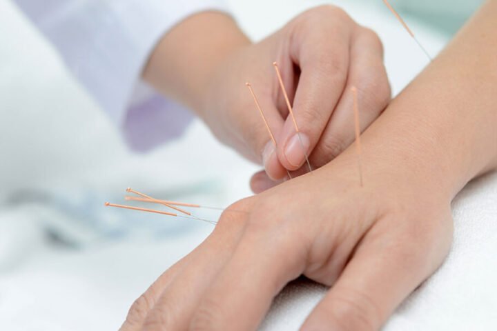 Acupuncture for Chronic Pain: Does It Actually Work?