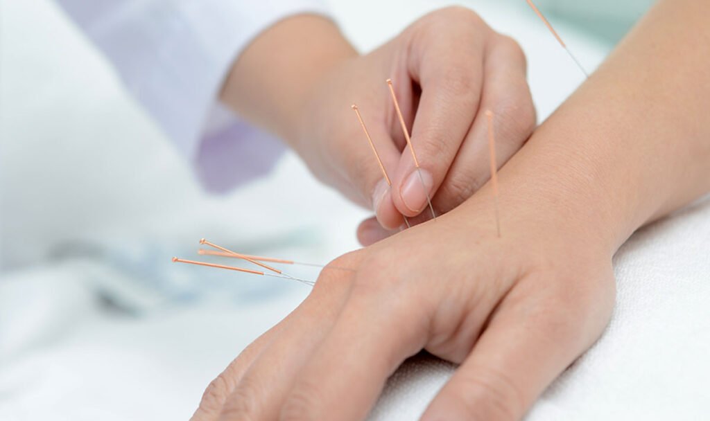 Acupuncture for Chronic Pain: Does It Actually Work?